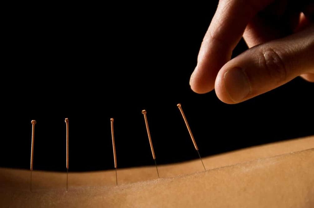acupuntura para prostatite