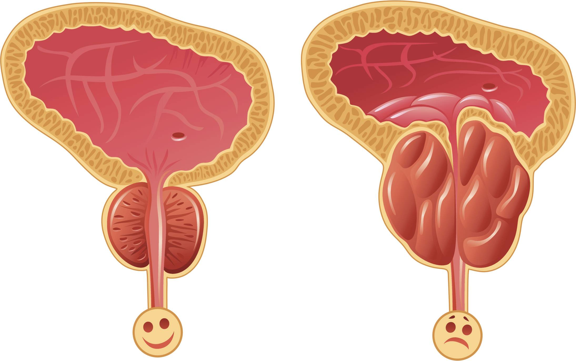 Como determinar a presença de prostatite