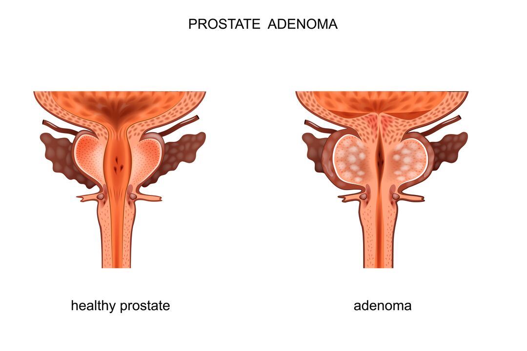 Próstata saudável e adenoma