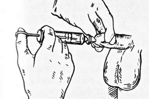 instilações para prostatite
