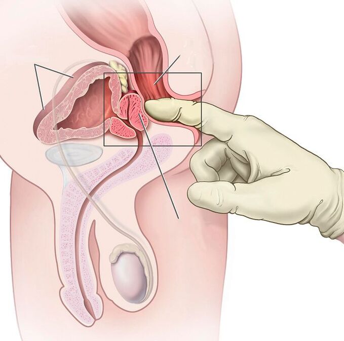 Massagem de próstata para tratamento de prostatite